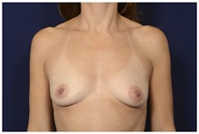 Breast Augmentation Before Photo by Michael Law, MD; Raleigh, NC - Case 33026