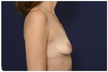 Breast Augmentation Before Photo by Michael Law, MD; Raleigh, NC - Case 33026