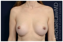 Breast Augmentation After Photo by Michael Law, MD; Raleigh, NC - Case 33029