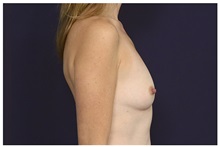 Breast Augmentation Before Photo by Michael Law, MD; Raleigh, NC - Case 33029