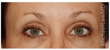 Eyelid Surgery After Photo by Michael Law, MD; Raleigh, NC - Case 33030