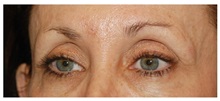 Eyelid Surgery Before Photo by Michael Law, MD; Raleigh, NC - Case 33030