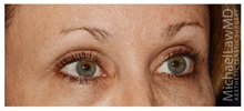 Eyelid Surgery After Photo by Michael Law, MD; Raleigh, NC - Case 33030