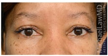Eyelid Surgery After Photo by Michael Law, MD; Raleigh, NC - Case 33033