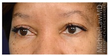 Eyelid Surgery After Photo by Michael Law, MD; Raleigh, NC - Case 33033