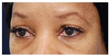 Eyelid Surgery Before Photo by Michael Law, MD; Raleigh, NC - Case 33033