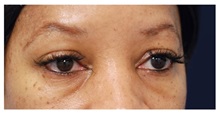 Eyelid Surgery Before Photo by Michael Law, MD; Raleigh, NC - Case 33033