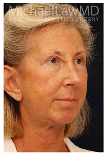 Facelift After Photo by Michael Law, MD; Raleigh, NC - Case 33034