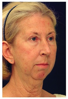 Facelift Before Photo by Michael Law, MD; Raleigh, NC - Case 33034