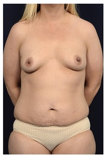 Body Contouring Before Photo by Michael Law, MD; Raleigh, NC - Case 33038
