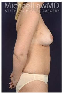 Body Contouring After Photo by Michael Law, MD; Raleigh, NC - Case 33038
