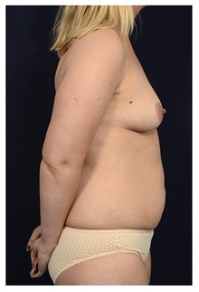Body Contouring Before Photo by Michael Law, MD; Raleigh, NC - Case 33038