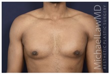 Male Breast Reduction After Photo by Michael Law, MD; Raleigh, NC - Case 33042