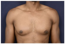 Male Breast Reduction Before Photo by Michael Law, MD; Raleigh, NC - Case 33042
