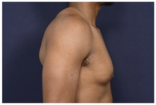 Male Breast Reduction Before Photo by Michael Law, MD; Raleigh, NC - Case 33042