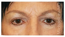 Eyelid Surgery After Photo by Michael Law, MD; Raleigh, NC - Case 33044
