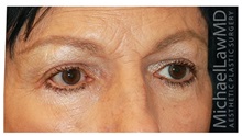 Eyelid Surgery After Photo by Michael Law, MD; Raleigh, NC - Case 33044