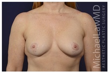 Breast Lift After Photo by Michael Law, MD; Raleigh, NC - Case 33046
