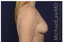 Breast Lift After Photo by Michael Law, MD; Raleigh, NC - Case 33046