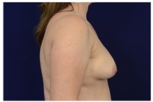 Breast Lift Before Photo by Michael Law, MD; Raleigh, NC - Case 33046