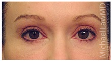 Eyelid Surgery After Photo by Michael Law, MD; Raleigh, NC - Case 33063