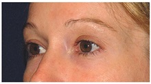 Eyelid Surgery Before Photo by Michael Law, MD; Raleigh, NC - Case 33063