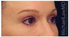 Eyelid Surgery After Photo by Michael Law, MD; Raleigh, NC - Case 33063
