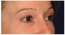 Eyelid Surgery Before Photo by Michael Law, MD; Raleigh, NC - Case 33063
