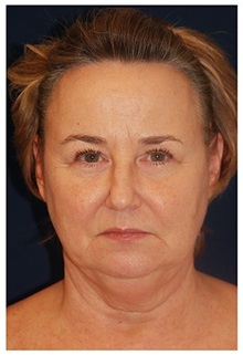 Facelift Before Photo by Michael Law, MD; Raleigh, NC - Case 33064