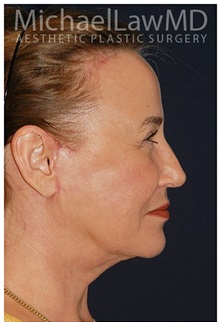 Facelift After Photo by Michael Law, MD; Raleigh, NC - Case 33064