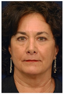 Facelift Before Photo by Michael Law, MD; Raleigh, NC - Case 33065