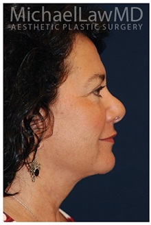 Facelift After Photo by Michael Law, MD; Raleigh, NC - Case 33065