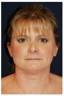 Facelift Before Photo by Michael Law, MD; Raleigh, NC - Case 33066