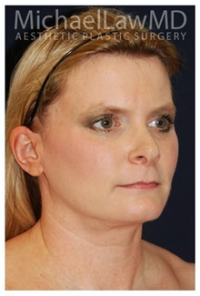 Facelift After Photo by Michael Law, MD; Raleigh, NC - Case 33066