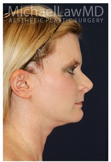 Facelift After Photo by Michael Law, MD; Raleigh, NC - Case 33066