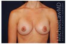 Breast Augmentation After Photo by Michael Law, MD; Raleigh, NC - Case 33067