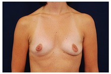 Breast Augmentation Before Photo by Michael Law, MD; Raleigh, NC - Case 33067