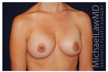 Breast Augmentation After Photo by Michael Law, MD; Raleigh, NC - Case 33067