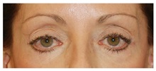 Eyelid Surgery Before Photo by Michael Law, MD; Raleigh, NC - Case 33068