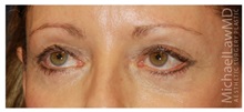 Eyelid Surgery After Photo by Michael Law, MD; Raleigh, NC - Case 33068