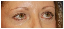 Eyelid Surgery After Photo by Michael Law, MD; Raleigh, NC - Case 33068