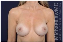 Breast Augmentation After Photo by Michael Law, MD; Raleigh, NC - Case 33101