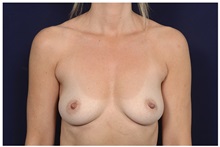 Breast Augmentation Before Photo by Michael Law, MD; Raleigh, NC - Case 33101
