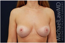 Breast Augmentation After Photo by Michael Law, MD; Raleigh, NC - Case 33105