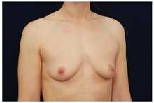 Breast Augmentation Before Photo by Michael Law, MD; Raleigh, NC - Case 33105