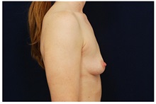 Breast Augmentation Before Photo by Michael Law, MD; Raleigh, NC - Case 33105