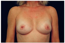 Breast Augmentation After Photo by Michael Law, MD; Raleigh, NC - Case 33107