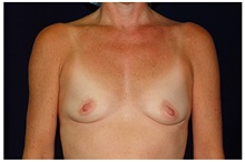Breast Augmentation Before Photo by Michael Law, MD; Raleigh, NC - Case 33107