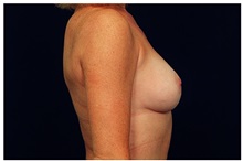 Breast Augmentation After Photo by Michael Law, MD; Raleigh, NC - Case 33107