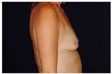 Breast Augmentation Before Photo by Michael Law, MD; Raleigh, NC - Case 33107